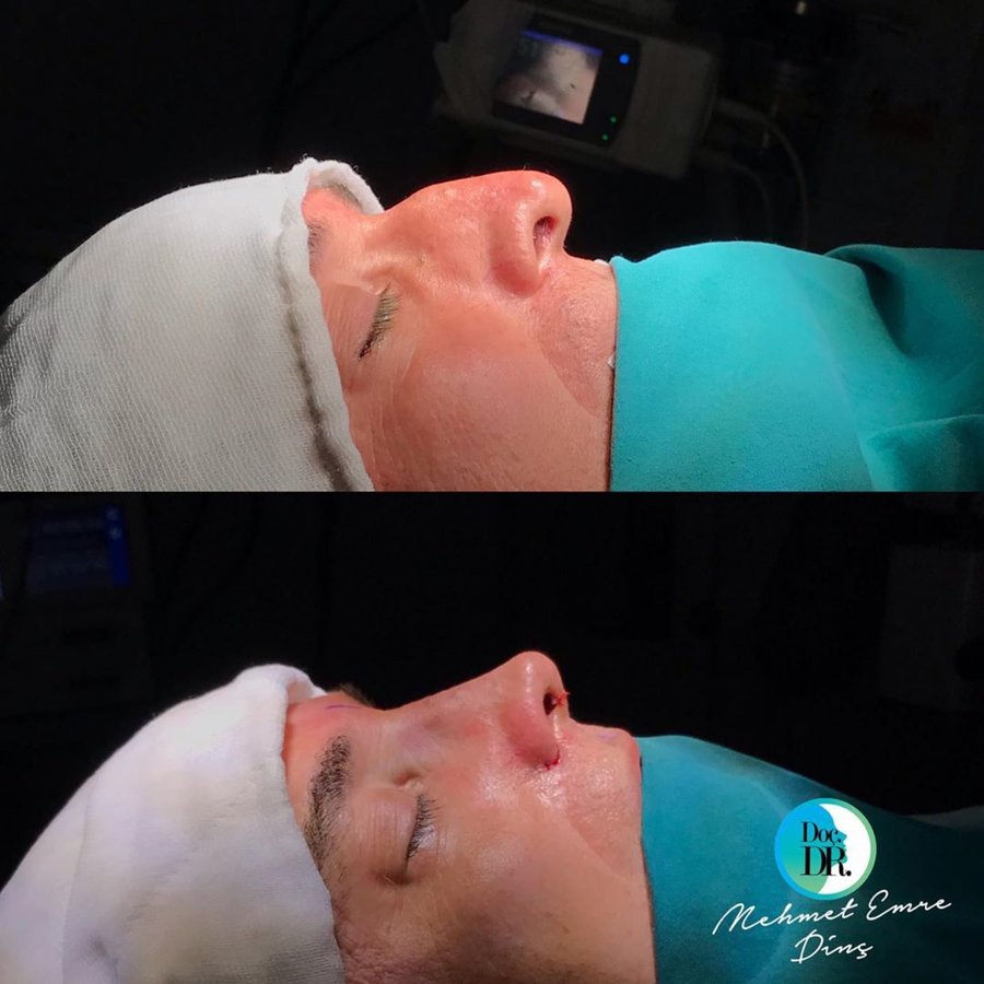 مساعد الأستاذ الدكتور محمد إمري دينك - مركز اسطنبول لجراحة الأنف - Assoc. Prof. Dr. Mehmet Emre Dinc - Istanbul Rhinoplasty Center