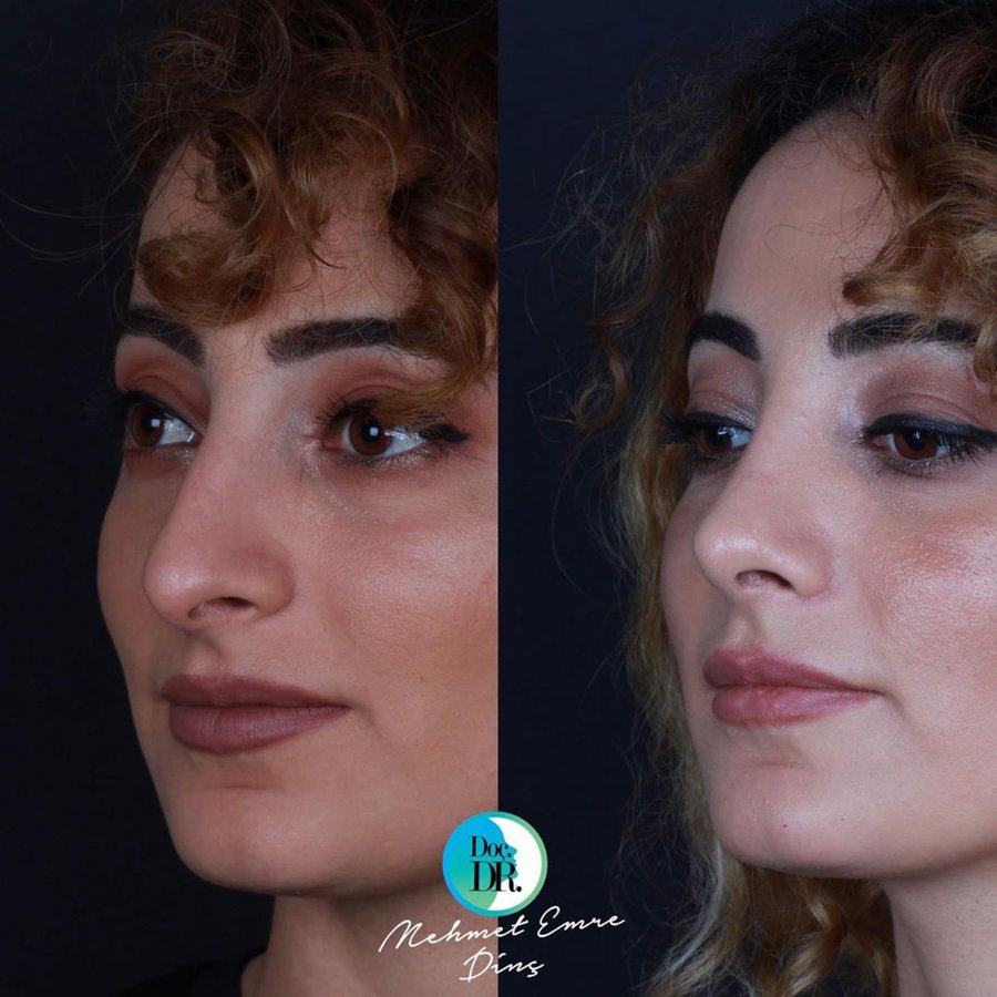 مساعد الأستاذ الدكتور محمد إمري دينك - مركز اسطنبول لجراحة الأنف - Assoc. Prof. Dr. Mehmet Emre Dinc - Istanbul Rhinoplasty Center