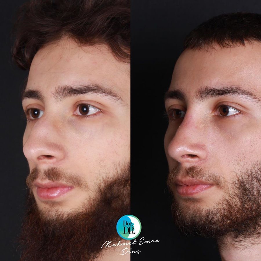 مساعد الأستاذ الدكتور محمد إمري دينك - مركز اسطنبول لجراحة الأنف - Assoc. Prof. Dr. Mehmet Emre Dinc - Istanbul Rhinoplasty Center