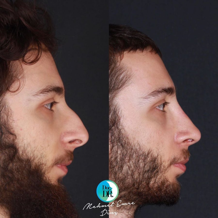 مساعد الأستاذ الدكتور محمد إمري دينك - مركز اسطنبول لجراحة الأنف - Assoc. Prof. Dr. Mehmet Emre Dinc - Istanbul Rhinoplasty Center