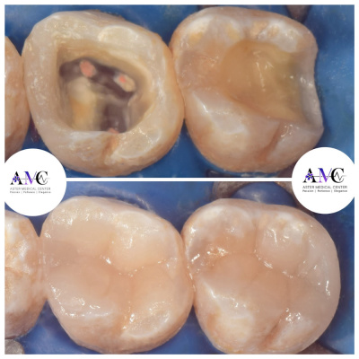 Aster Medical Center د. محمد حسن  - filling 