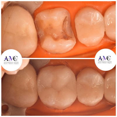 Aster Medical Center د. محمد حسن  - composite crown 