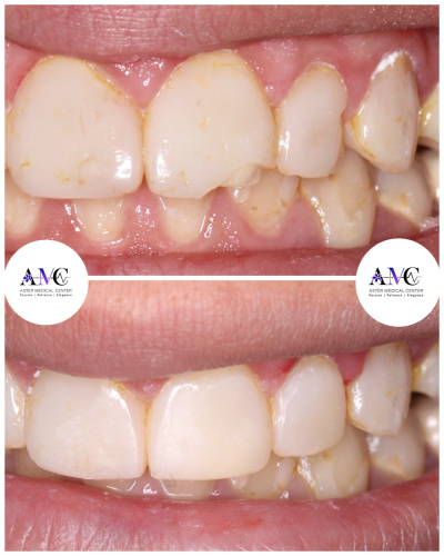 Aster Medical Center د. محمد حسن  - composite veneer 