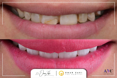 Aster Medical Center د. محمد حسن  - smile makeover 