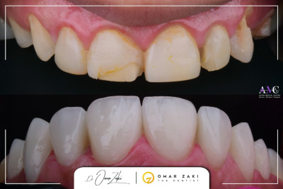 Aster Medical Center د. محمد حسن  - e max veneers 