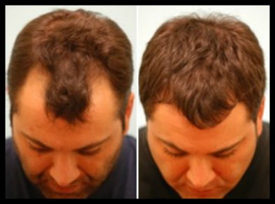 Australian Institute of Hair Restoration - Melbourne - Australian Institute of Hair Restoration - Melbourne