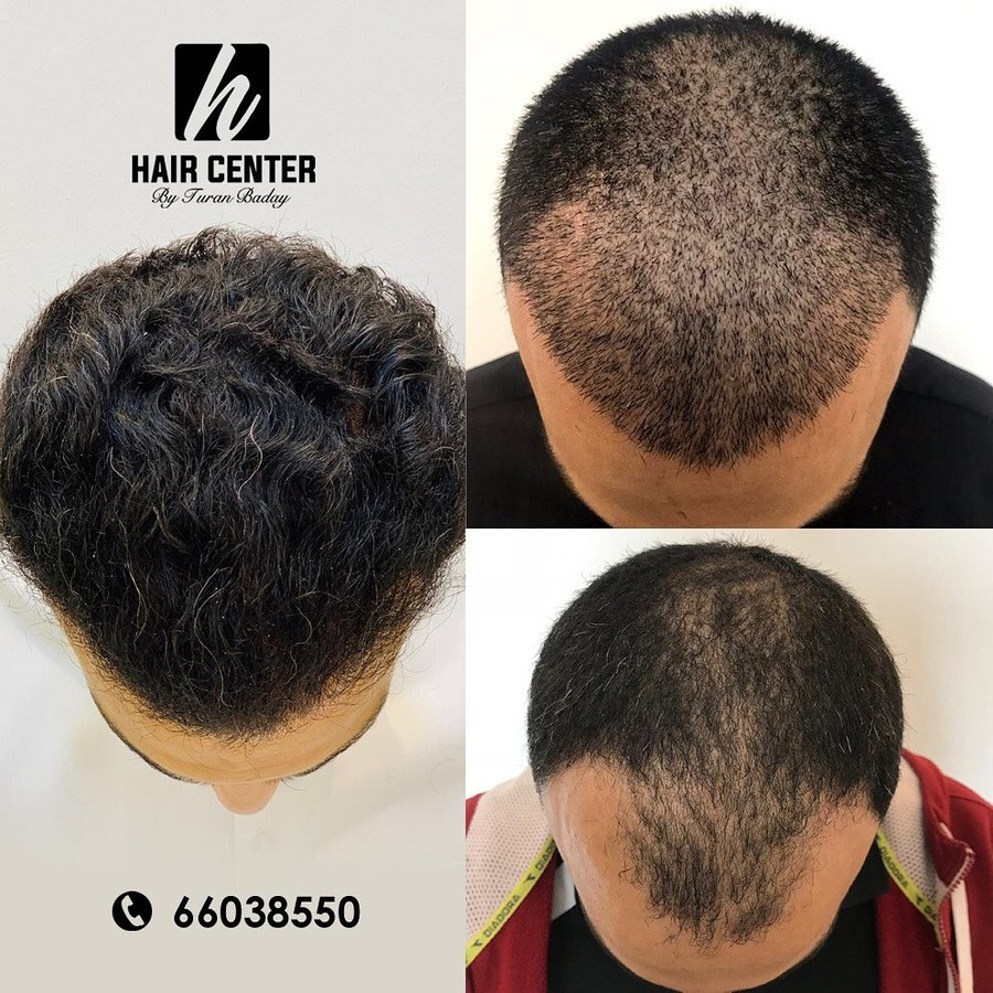 مركز باداي للشعر - Baday Hair Center