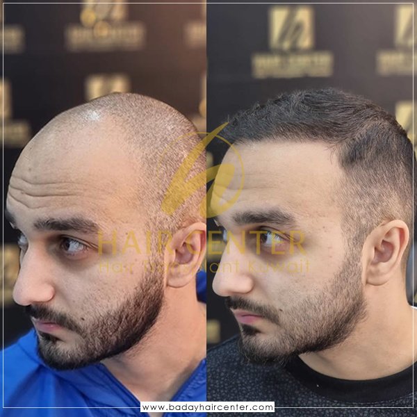 مركز باداي للشعر - Baday Hair Center