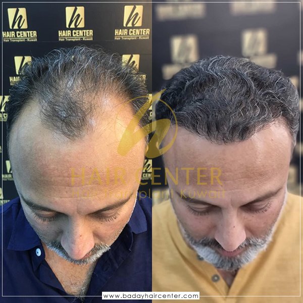 مركز باداي للشعر - Baday Hair Center