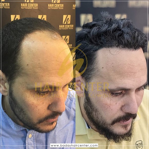 مركز باداي للشعر - Baday Hair Center