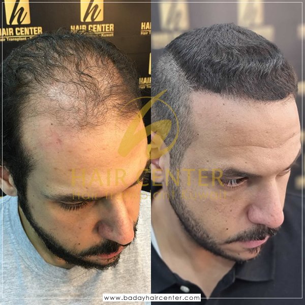 مركز باداي للشعر - Baday Hair Center