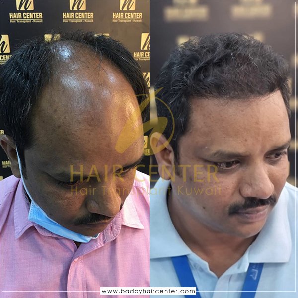 مركز باداي للشعر - Baday Hair Center