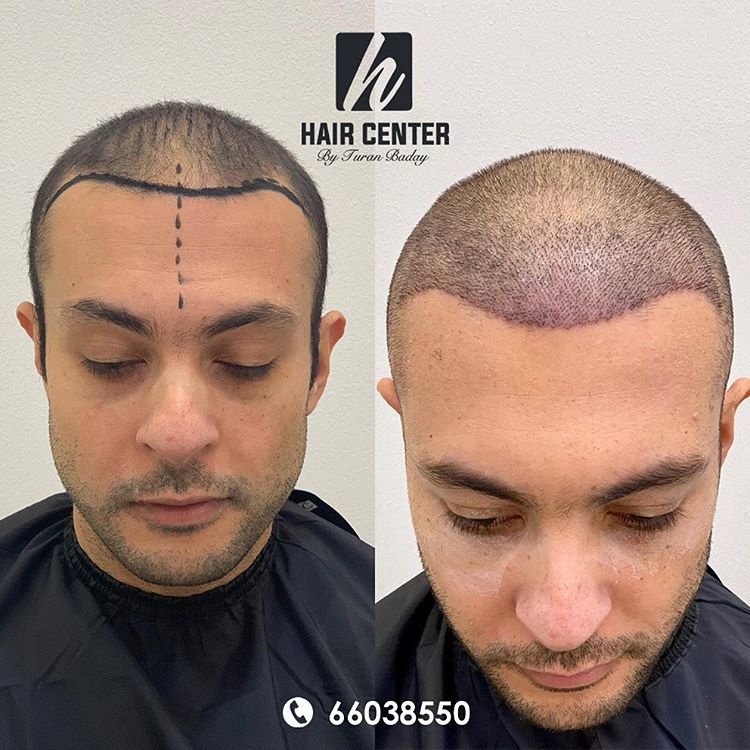 مركز باداي للشعر - Baday Hair Center