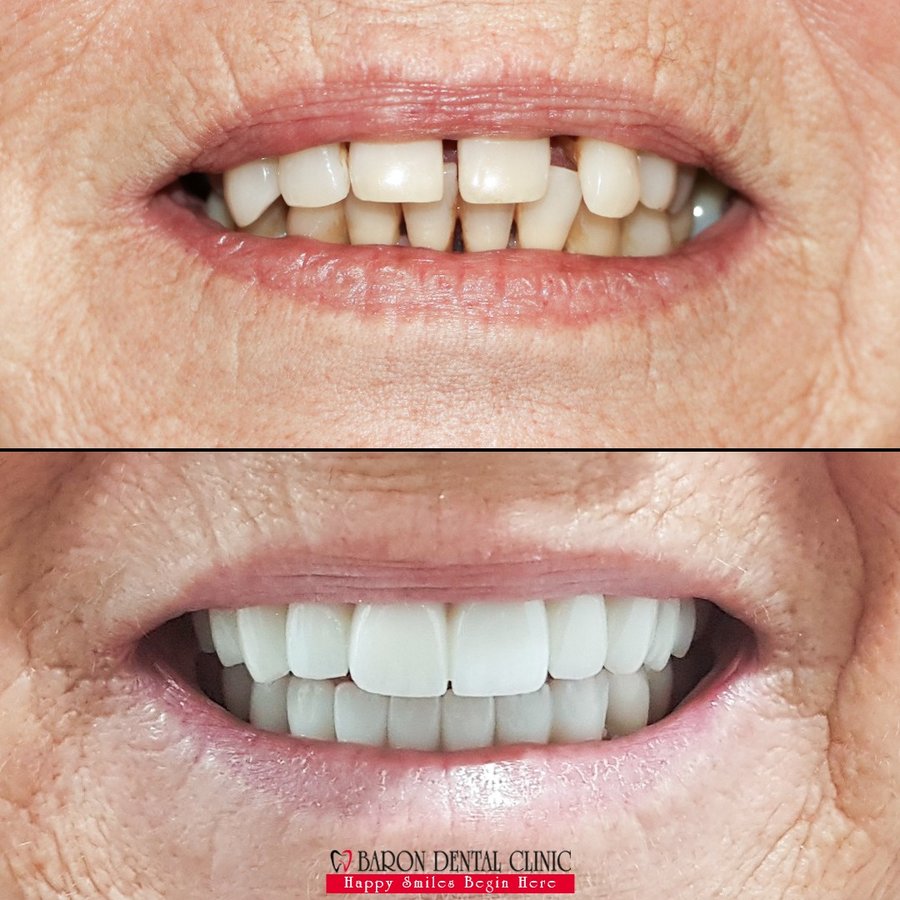 Baron Dental Clinic / Dental Tourism Antalya - Baron Dental Clinic / Dental Tourism Antalya