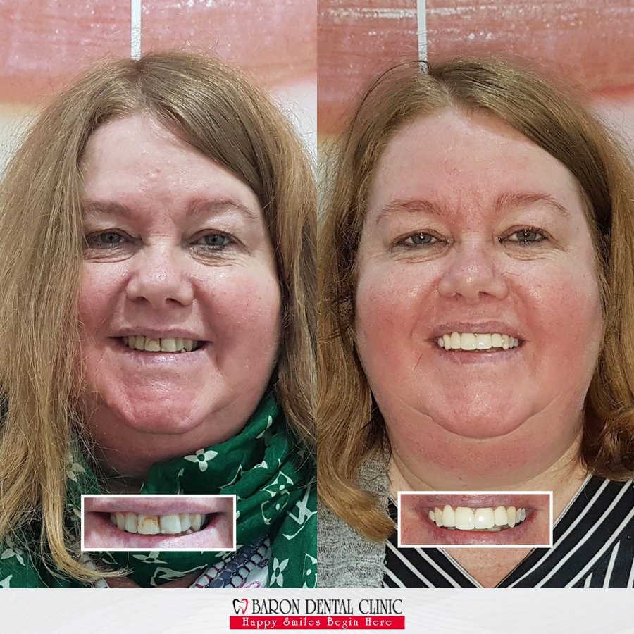 Baron Dental Clinic / Dental Tourism Antalya - Baron Dental Clinic / Dental Tourism Antalya