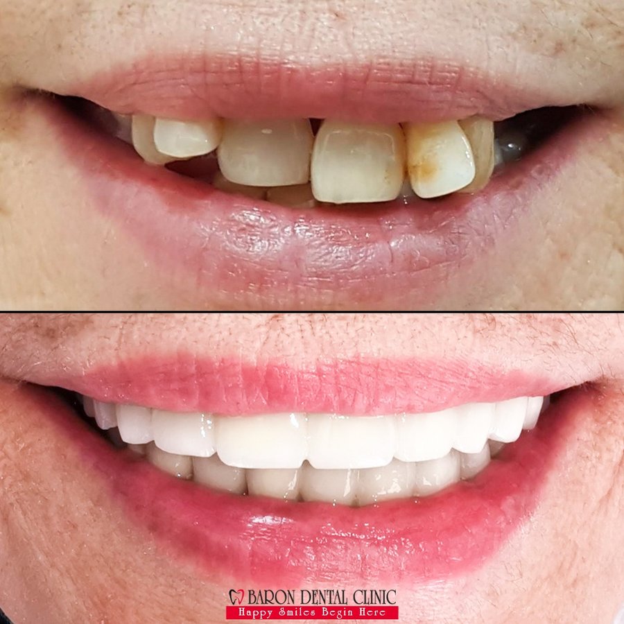 Baron Dental Clinic / Dental Tourism Antalya - Baron Dental Clinic / Dental Tourism Antalya