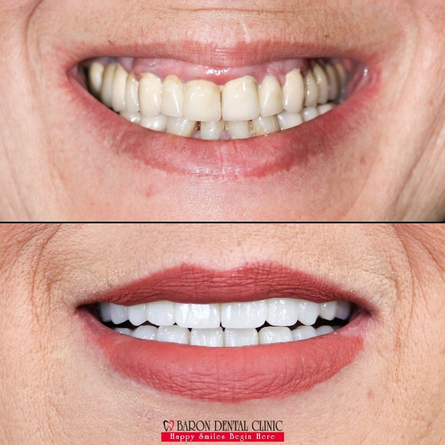 Baron Dental Clinic / Dental Tourism Antalya - Baron Dental Clinic / Dental Tourism Antalya