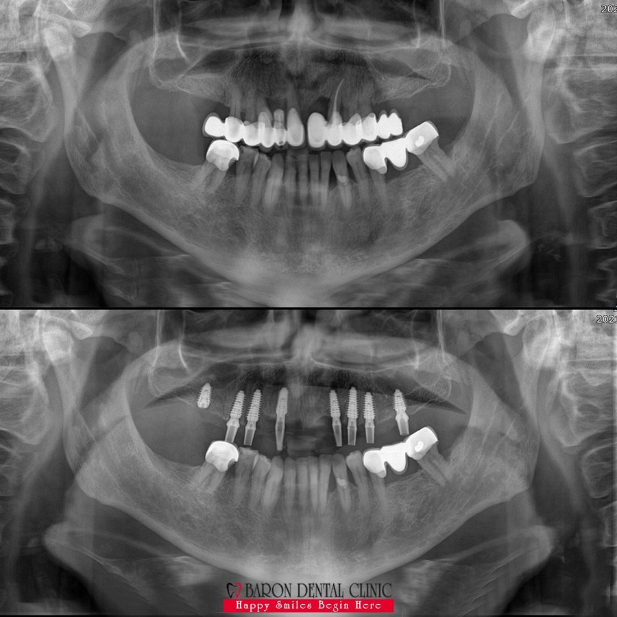 Baron Dental Clinic / Dental Tourism Antalya - Baron Dental Clinic / Dental Tourism Antalya