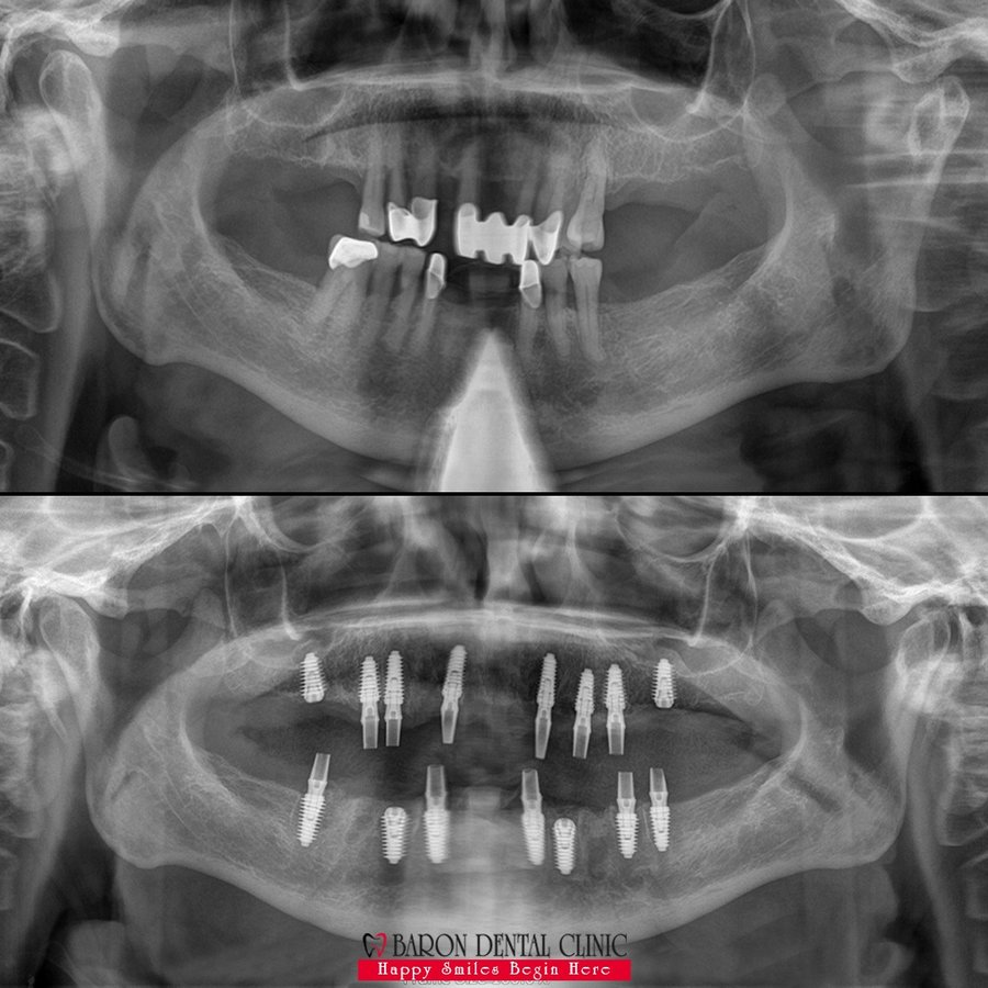 Baron Dental Clinic / Dental Tourism Antalya - Baron Dental Clinic / Dental Tourism Antalya