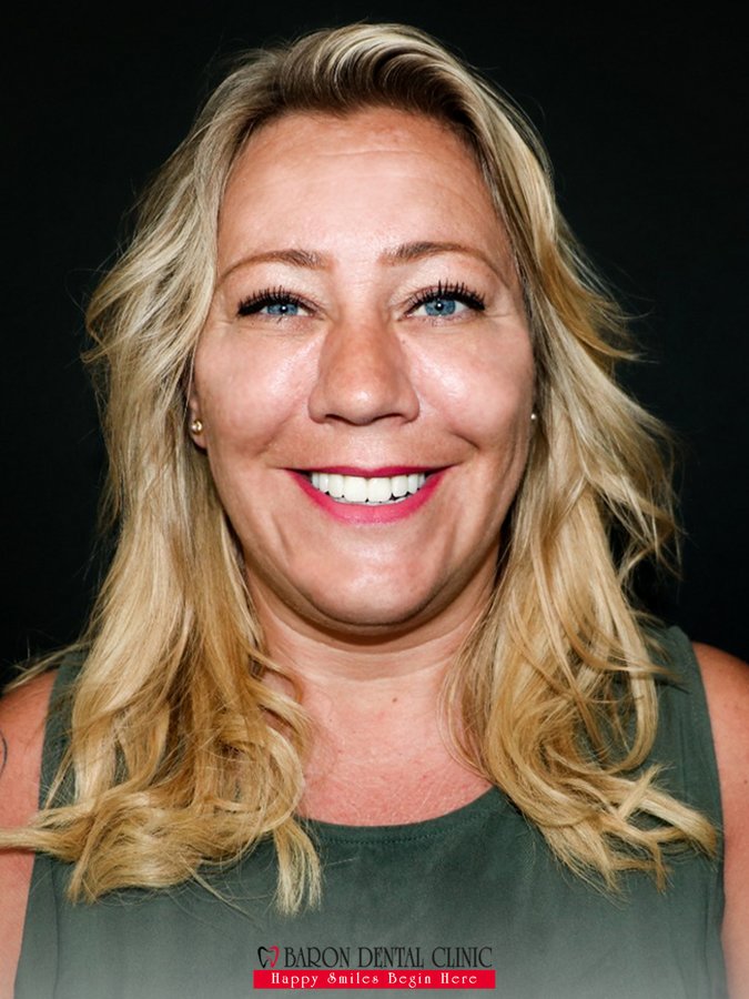 Baron Dental Clinic / Dental Tourism Antalya - Baron Dental Clinic / Dental Tourism Antalya