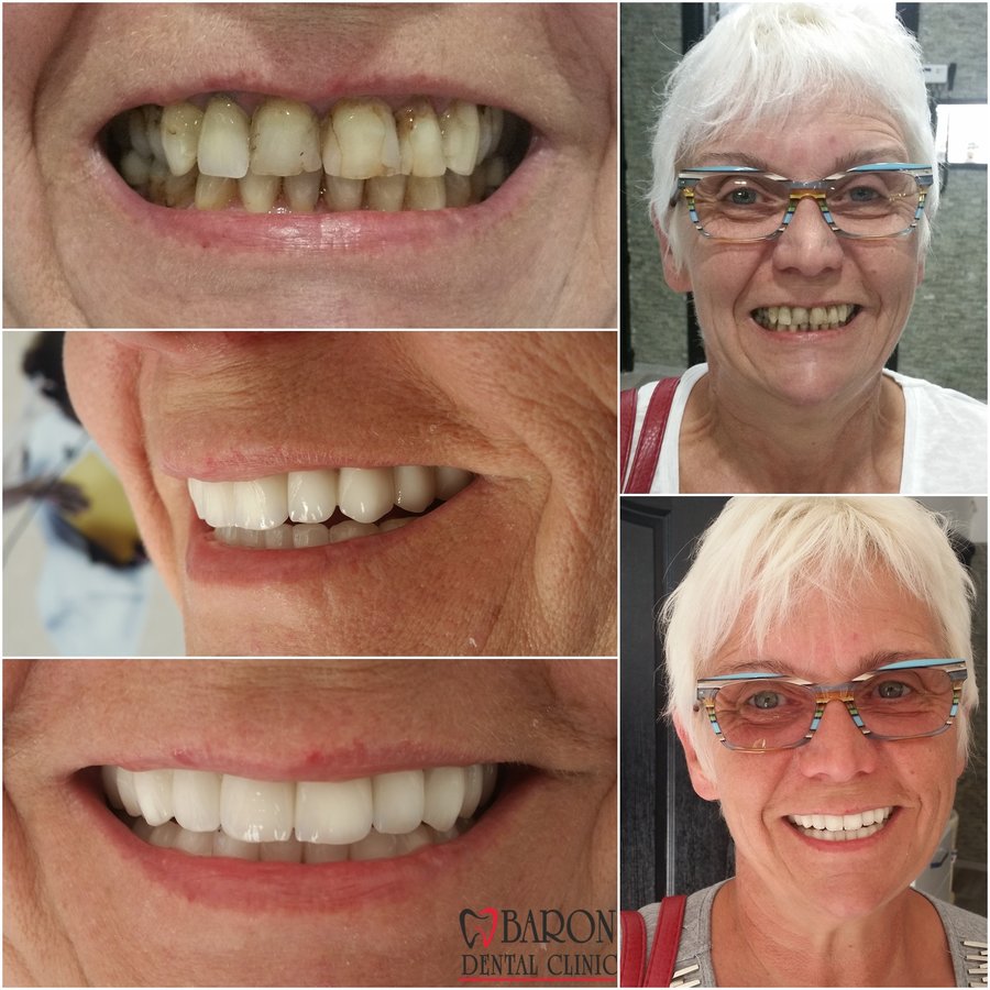 Baron Dental Clinic / Dental Tourism Antalya - Baron Dental Clinic / Dental Tourism Antalya