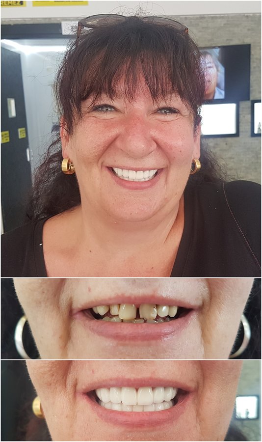 Baron Dental Clinic / Dental Tourism Antalya - Baron Dental Clinic / Dental Tourism Antalya