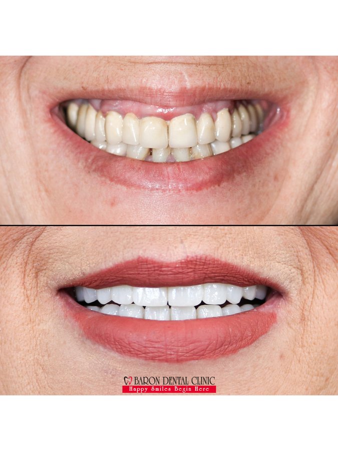 Baron Dental Clinic / Dental Tourism Antalya - Baron Dental Clinic / Dental Tourism Antalya