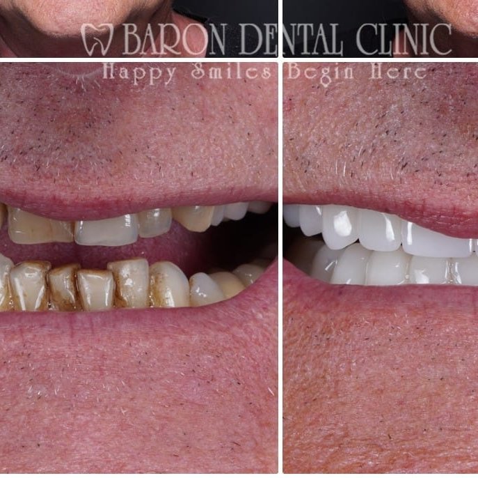 Baron Dental Clinic / Dental Tourism Antalya - Baron Dental Clinic / Dental Tourism Antalya