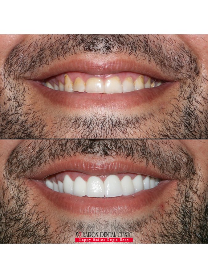 Baron Dental Clinic / Dental Tourism Antalya - Baron Dental Clinic / Dental Tourism Antalya