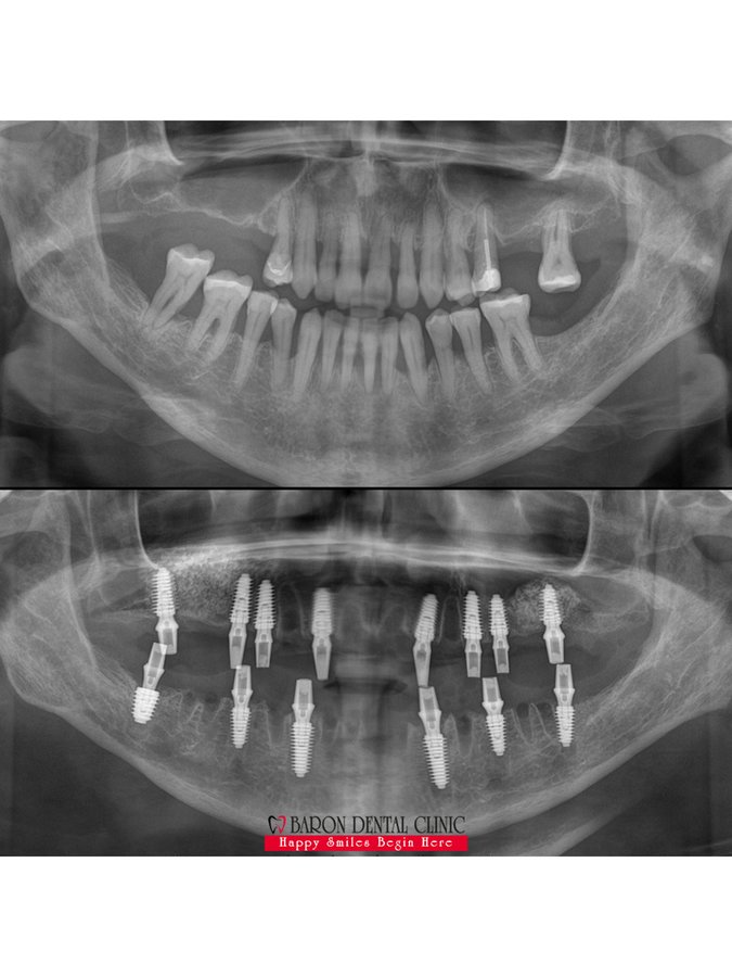 Baron Dental Clinic / Dental Tourism Antalya - Baron Dental Clinic / Dental Tourism Antalya