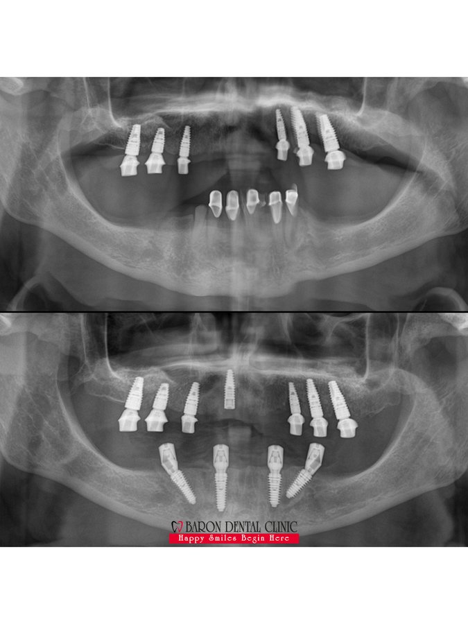 Baron Dental Clinic / Dental Tourism Antalya - Baron Dental Clinic / Dental Tourism Antalya