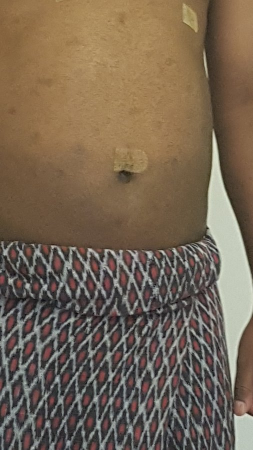 Beauty and FUE - Beauty and FUE