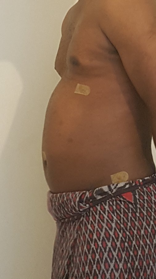 Beauty and FUE - Beauty and FUE