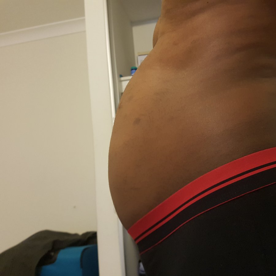 Beauty and FUE - Beauty and FUE