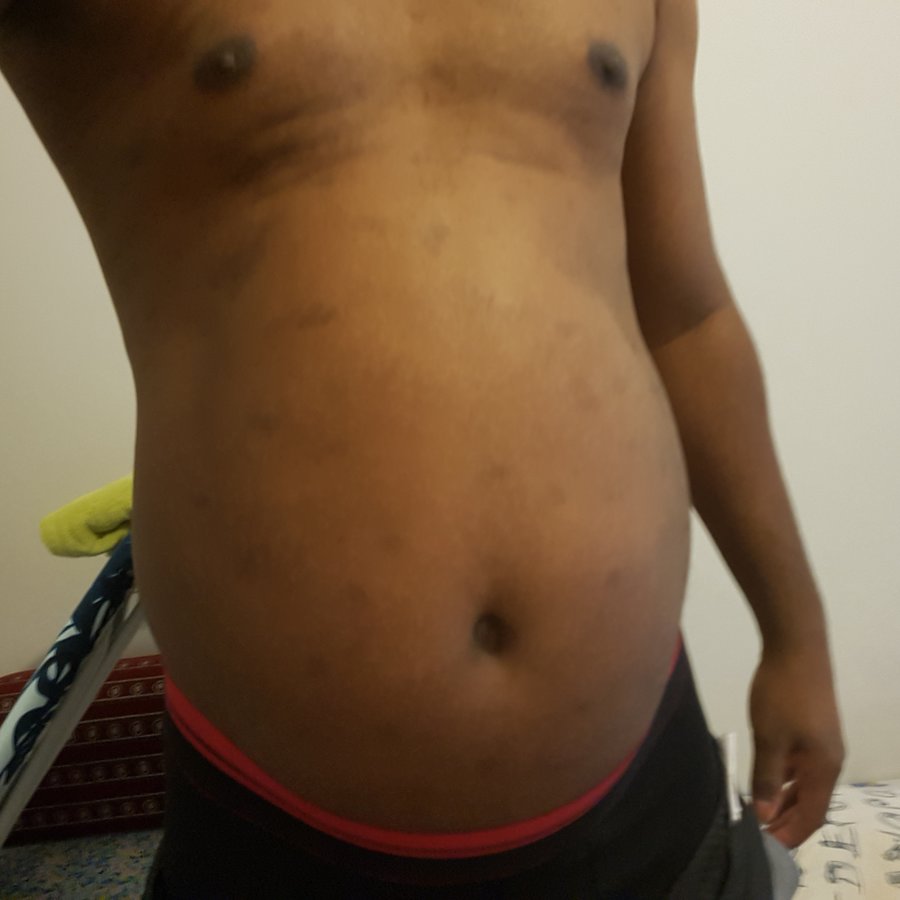 Beauty and FUE - Beauty and FUE