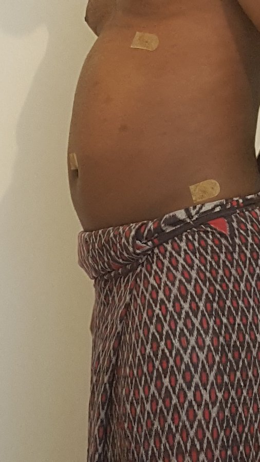 Beauty and FUE - Beauty and FUE