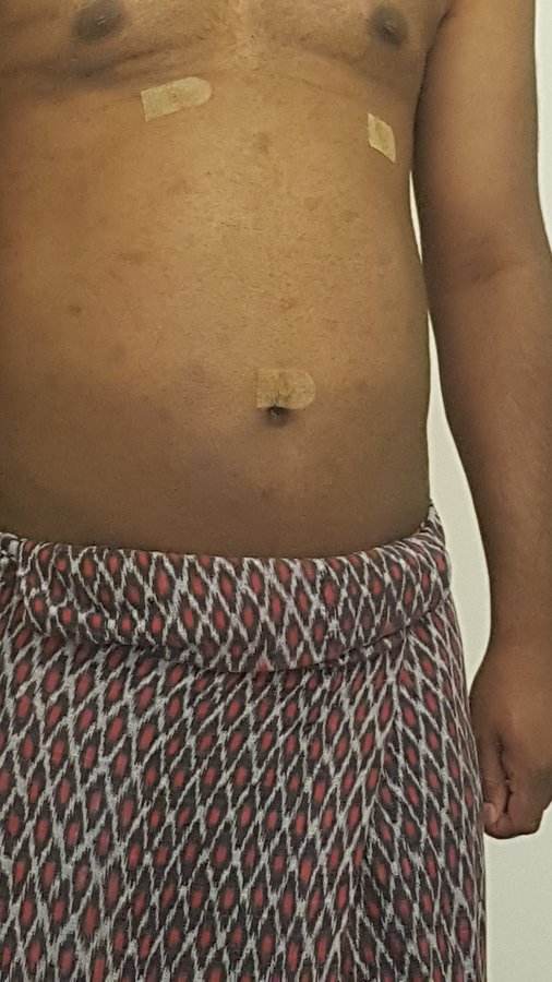 Beauty and FUE - Beauty and FUE