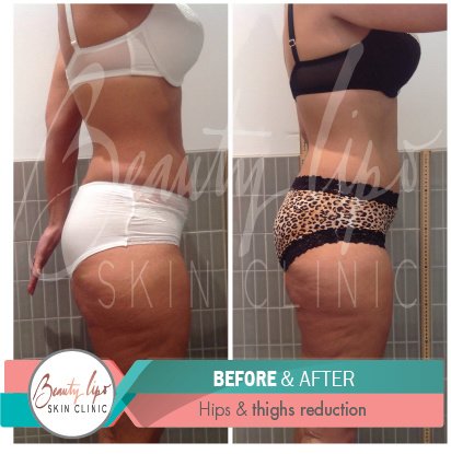 Beauty Lipo - Beauty Lipo