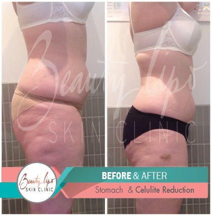 Beauty Lipo - Beauty Lipo