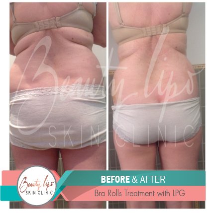 Beauty Lipo - Beauty Lipo