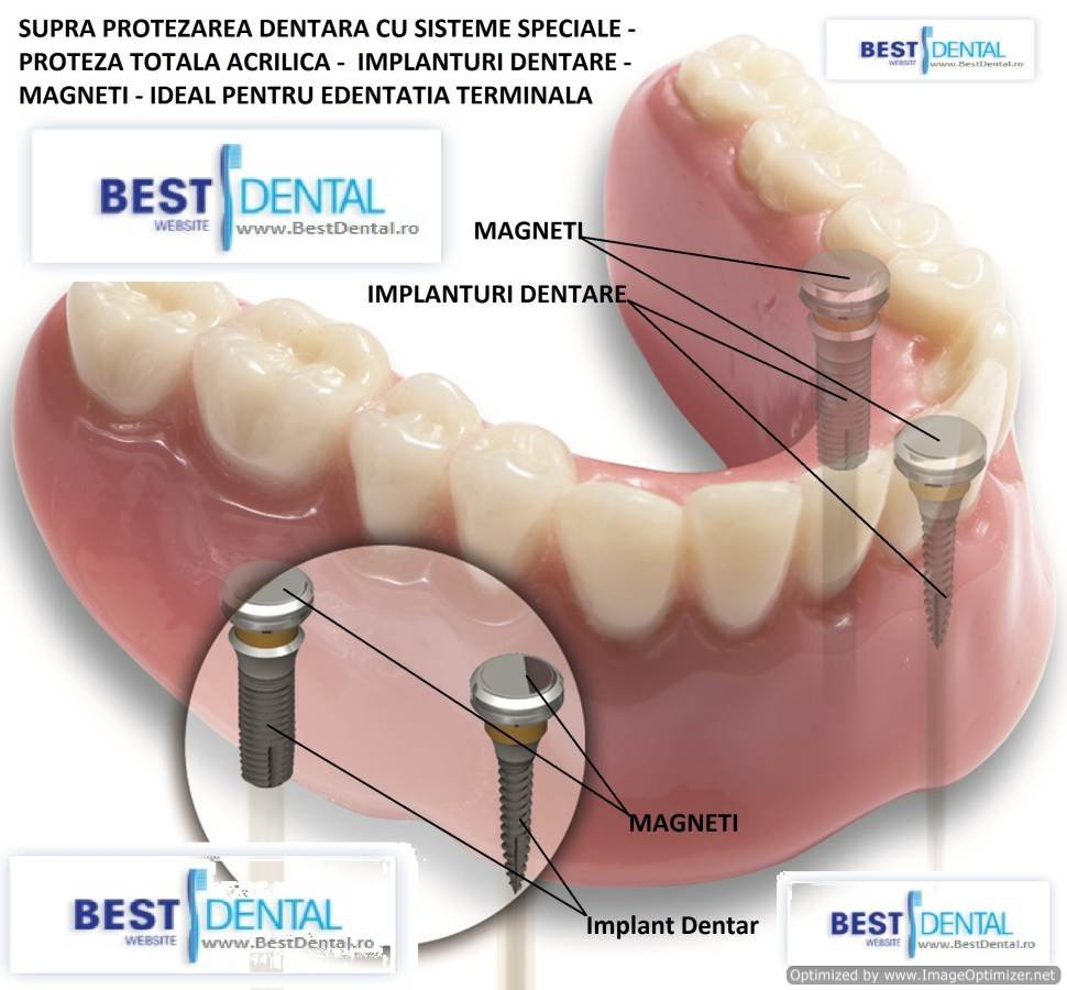 Best Dental Implant Dent Tehnic - Best Dental Implant Dent Tehnic
