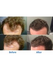 عيادات أفضل لزراعة الشعر - برمنغهام - Better Hair Transplant Clinics - Birmingham