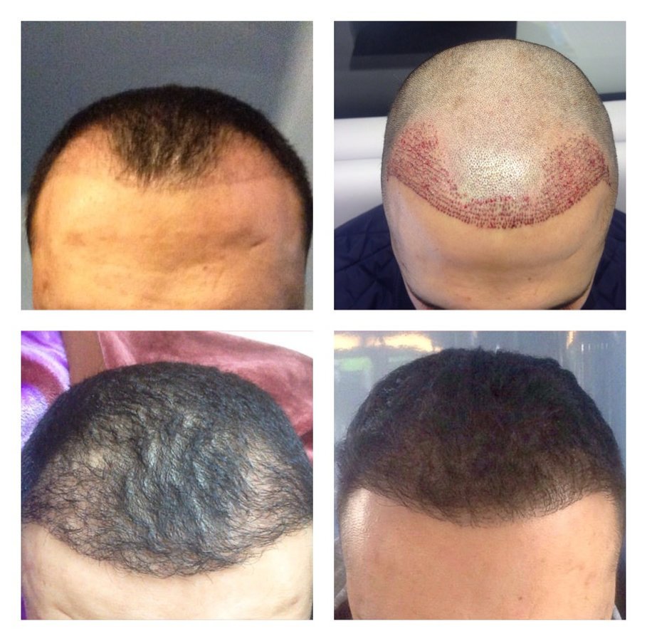 عيادات أفضل لزراعة الشعر - برمنغهام - Better Hair Transplant Clinics - Birmingham