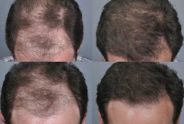 عيادات أفضل لزراعة الشعر - برمنغهام - Better Hair Transplant Clinics - Birmingham