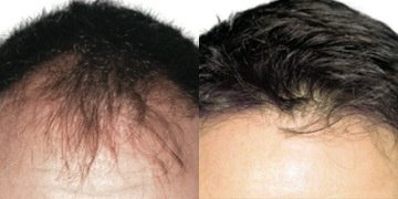 عيادات أفضل لزراعة الشعر - كارديف - Better Hair Transplant Clinics - Cardiff