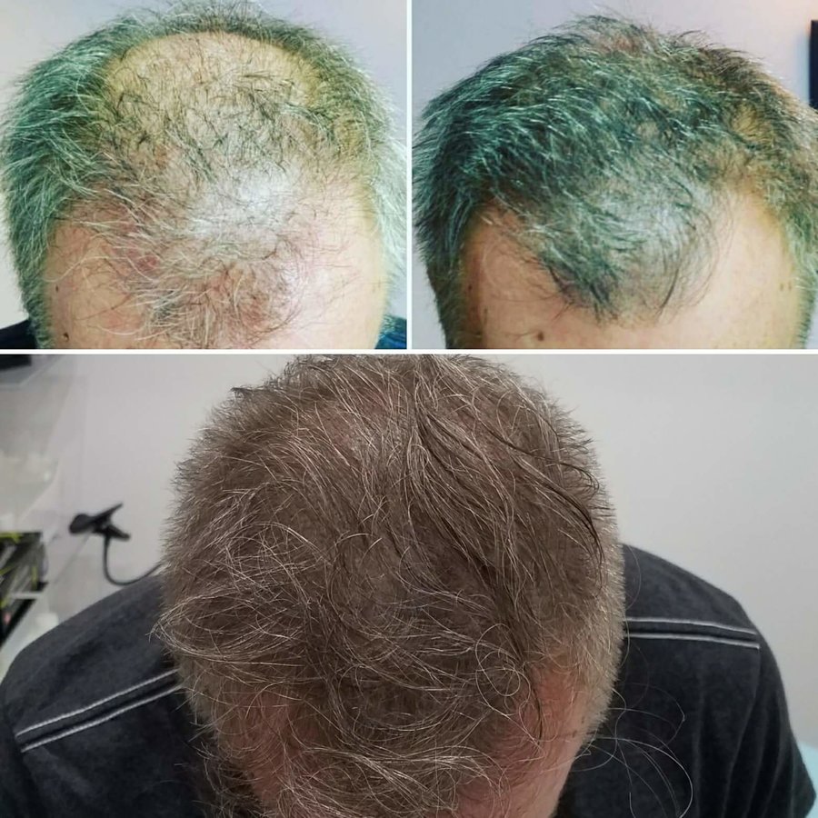 عيادات أفضل لزراعة الشعر - كارديف - Better Hair Transplant Clinics - Cardiff