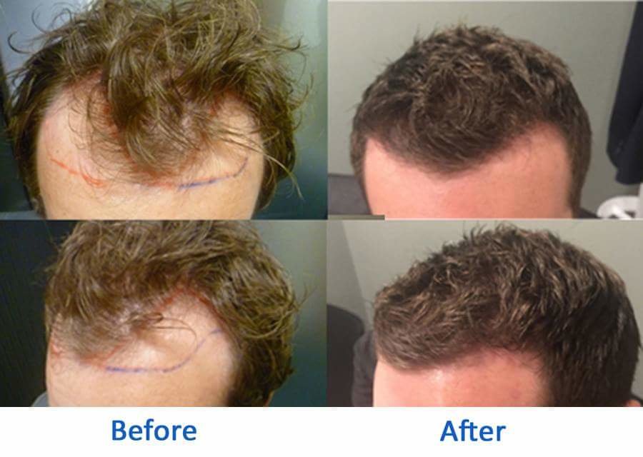 عيادات أفضل لزراعة الشعر - كارديف - Better Hair Transplant Clinics - Cardiff