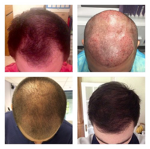 Better Hair Transplant Clinics - Nottingham - Better Hair Transplant Clinics - Nottingham