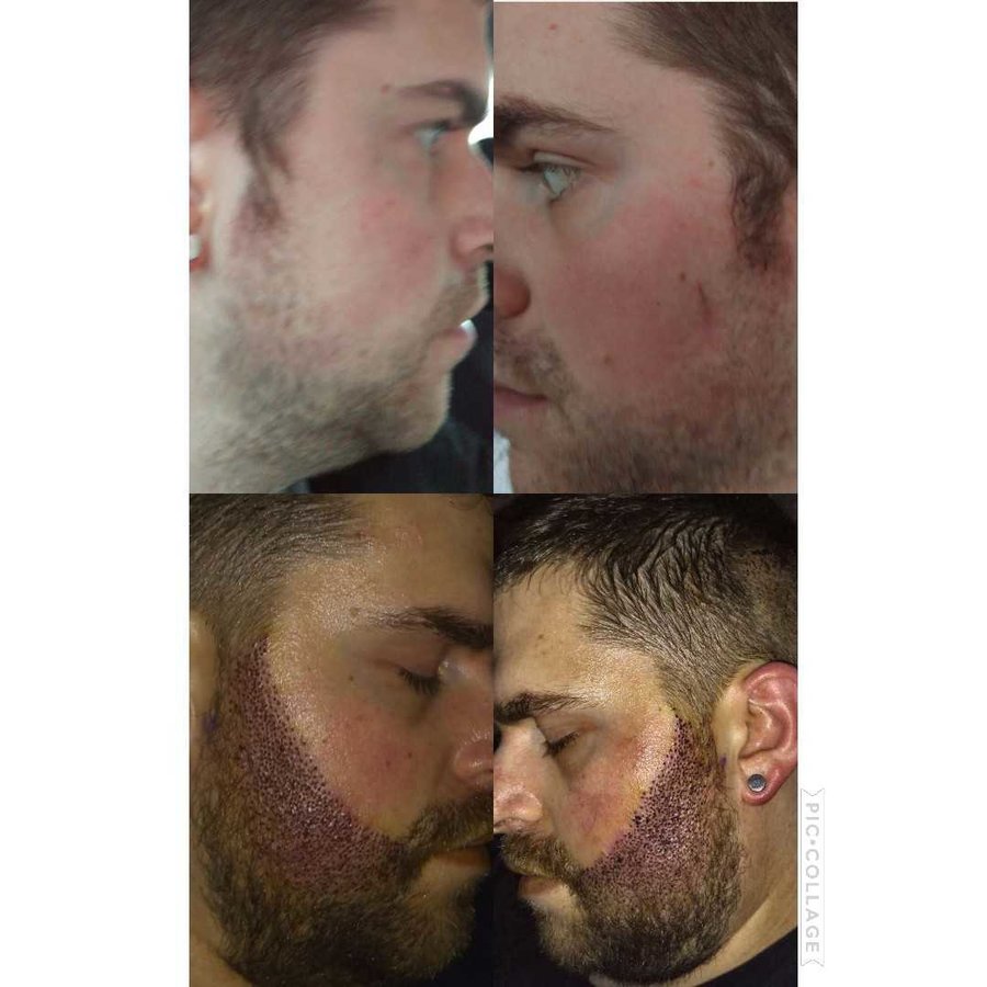 Better Hair Transplant Clinics - Nottingham - Better Hair Transplant Clinics - Nottingham