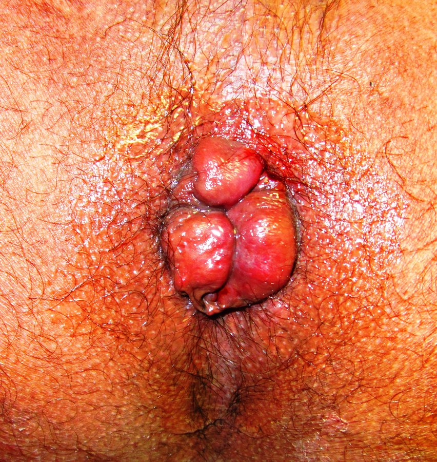 Bhopal Ayurvedic Surgical Center And Wound Clinic - Bhopal Ayurvedic Surgical Center And Wound Clinic